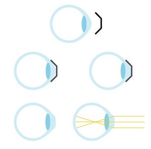 Otho-K on Eye diagram
